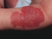 infantile hemangioma